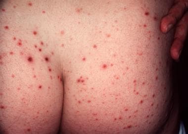 Typical hemorrhagic crusted papules of pityriasis 