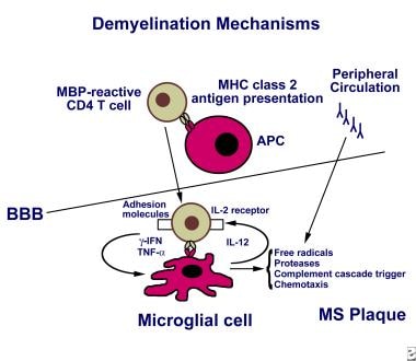 The mechanism of demyelination in multiple scleros