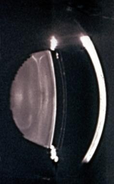 Slit lamp photograph of optical section of the ant