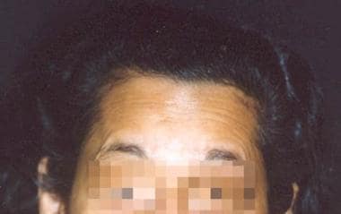 Preoperative view of forehead of an ideal patient.