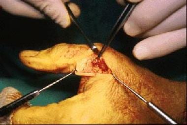 An intraoperative photograph of a Stener lesion. 