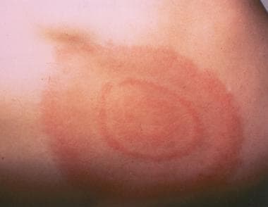Lyme disease. Classic target lesion with concentri
