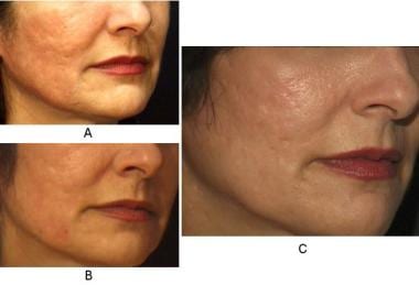 Atrophic acne scars before full-face carbon dioxid