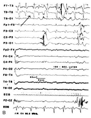 Infant with L focal paroxysmal temporal discharges