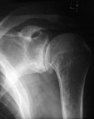 Radiograph showing glenohumeral joint space narrow