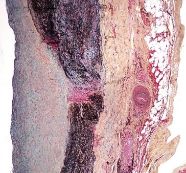 Thoracic Aortic Aneurysm Pathology. A 40-year-old