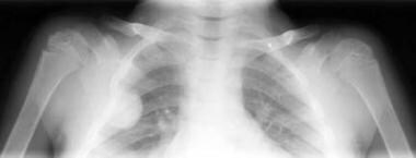 Thalassemia. Radiograph of the ribs. An osteoma is