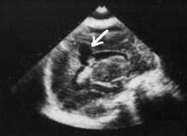 Sagittal ultrasonogram. The images shows cystic en