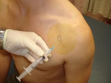 Subacromial injection of steroid