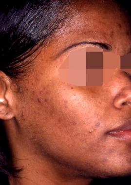 Acne with reactive hyperpigmentation; after treatm