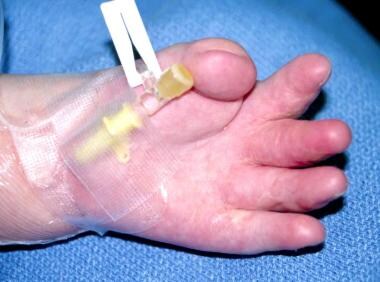 Left hand of patient with type II Apert syndrome.