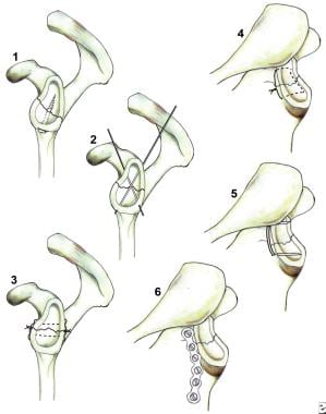 Illustrations depicting fixation techniques availa