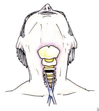 Guidewire dilating forceps (GWDF) technique. The g