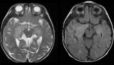 Pathology of Expansile Astrocytomas. The deeply si