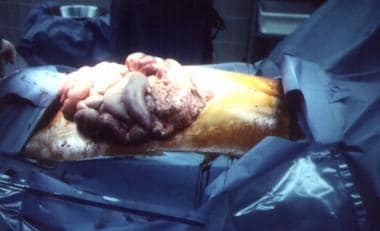 Edematous eviscerated bowel in patient with blunt 