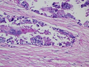 Pathology of nonmesothelial cancers of the pleura.
