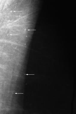 Multiple skin calcifications (arrows). 