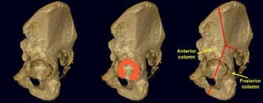 Lateral view of the left acetabulum. The left femu