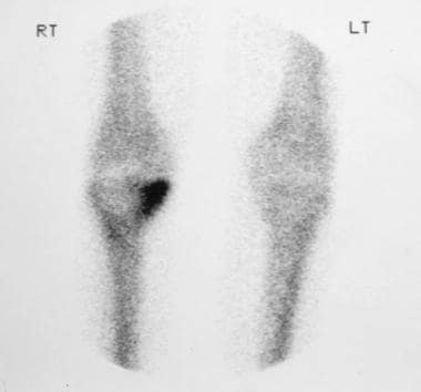 Radionuclide bone scan of the right knee joint in 
