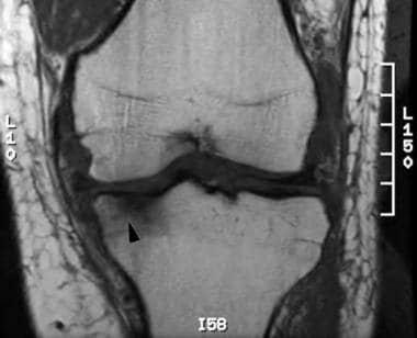 Coronal T1-weighted image of the knee demonstrates