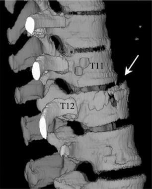 Thoracic spine trauma. Three-dimensional CT scan o