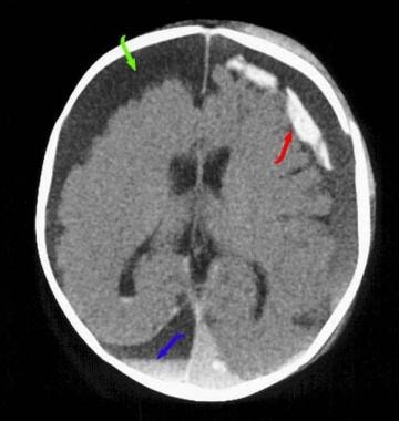 Child abuse - Emergency neuroradiology. Axial CT s