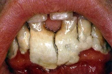 Dental calculus accumulations on the mandibular an