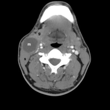 Second branchial cleft cyst. Contrast-enhanced CT 