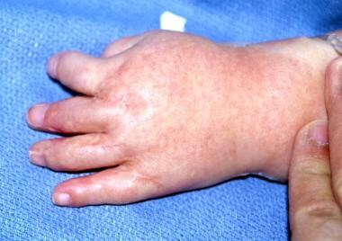 Dorsal view of left hand of patient with type II A