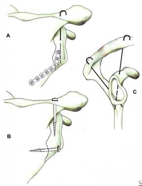Fixation of glenoid neck fractures. (A) stabilizat