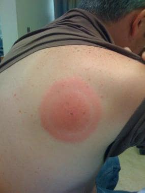 Lyme disease. Bulls-eye rash. 