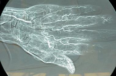 Distal ulnar artery occlusion and proximal radial