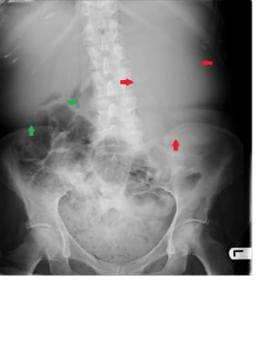 This abdominal radiograph of a 45-year-old patient