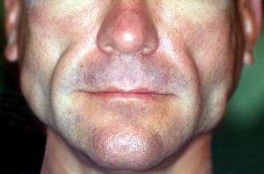 Facial HIV-associated lipodystrophy in a patient r
