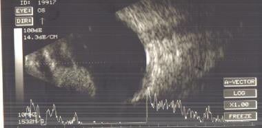 B-scan ultrasonogram of a patient with an iris mel