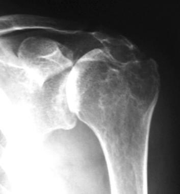 Radiograph of a severely affected joint demonstrat