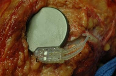 An implanted nerve stimulator. Note that the locat