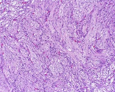 Pathology of Expansile Astrocytomas. The desmoplas