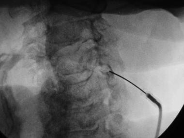 Cervical epidural steroid injection indications