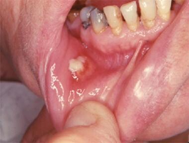 Cellulitis Of The Mouth 80