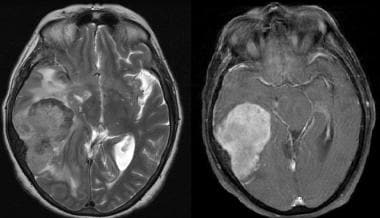 Multisequence MR images, including axial T2 and ax