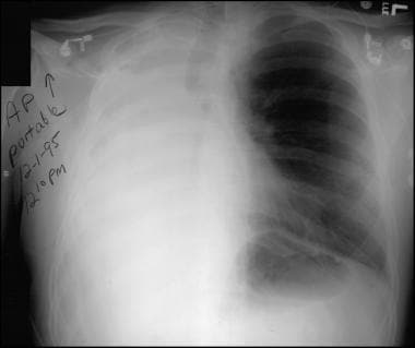 Frontal chest radiograph from a 26-year-old man af
