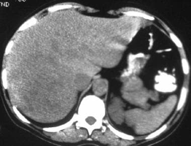 Noncontrast computed tomography scan in a 41-year-