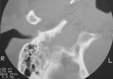 Glomus jugulare tumor. Computed tomography scan sh