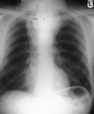 Posteroanterior chest radiograph shows a large ret