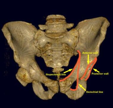 Anteroposterior view of the pelvis. The left femur
