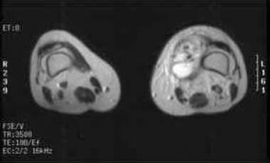 T2-weighted MRI obtained following gadolinium admi