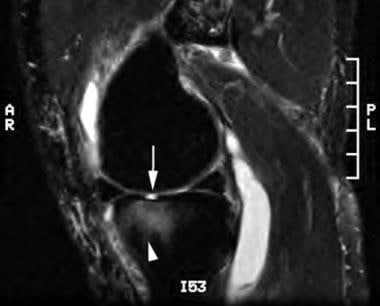 Sagittal T2-weighted image of the knee reveals an 