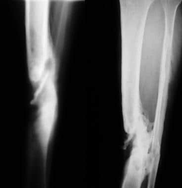 Osteomyelitis, chronic. Sequestrum of the lower ti