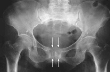 Anteroposterior radiograph of the pelvis demonstra